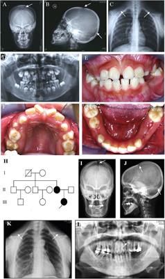 An Exploration of Mutagenesis in a Family with Cleidocranial Dysplasia without RUNX2 Mutation